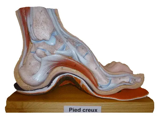 Semelles orthopédiques sur mesure pour pieds creux / sur RDV